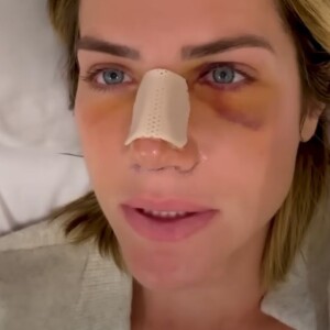 Cirurgia no nariz de Giovanna Ewbank foi feita para corrigir um desvio de septo