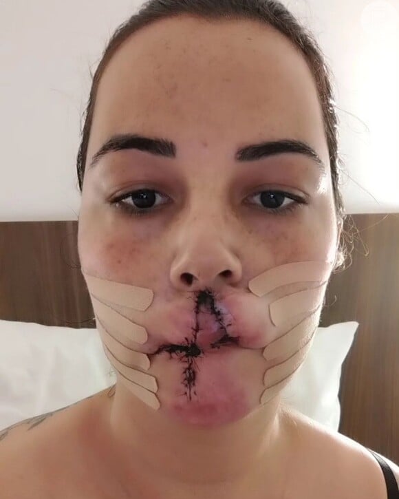 Mariana Micheline, de 35 anos, moradora de Matão (SP), teve complicações seis meses depois da cirurgia