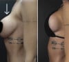 Maria Lina exibe foto dos seios depois de mastopexia com troca de prótese de silicone