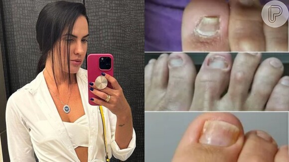 Graciele Lacerda teve, além dos seus pés criticados, um problema com as unhas que tratou com uma podóloga