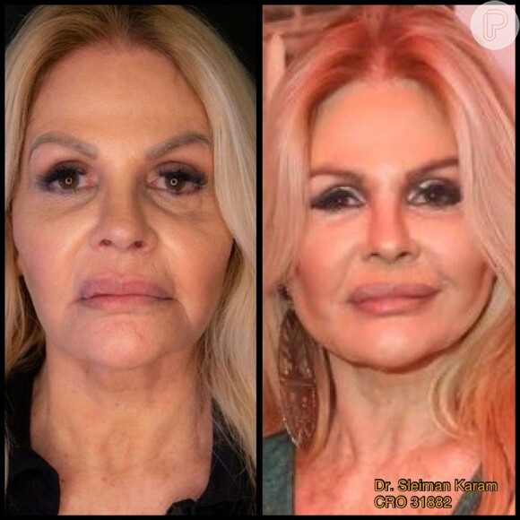 Para chegar com tudo no casamento, Monique Evans fez algumas mudanças, como uma harmonização facial