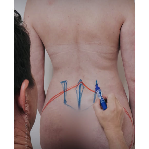 Entre os procedimentos feitos por Bárbara Evans estão até mesmo uma lipoaspiracão nas axilas