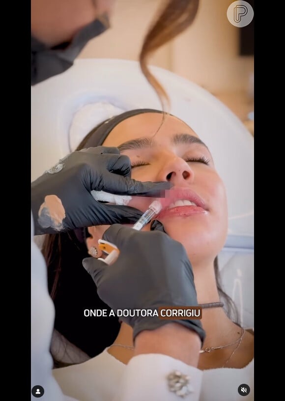 Duda Guerra, namorada de Benício Huck, explicou que harmonização facial, aos 16 anos, teve pouca aplicação de produtos