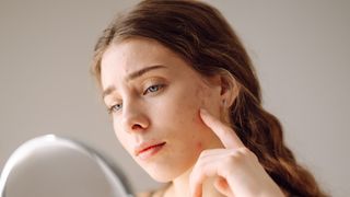 Pele acneica NUNCA mais! 3 produtos essenciais para dar um adeus definitivo a esse problema de pele