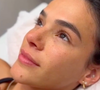 Feito na O&Ester, o procedimento escolhido por Bruna Marquezine busca deixar um resultado mais natural possível
