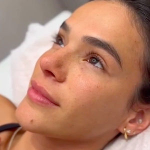 Feito na O&Ester, o procedimento escolhido por Bruna Marquezine busca deixar um resultado mais natural possível