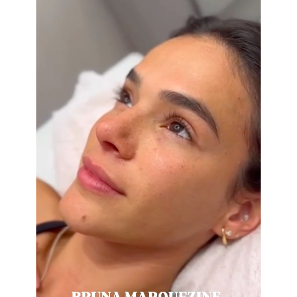 Feito na O&Ester, o procedimento escolhido por Bruna Marquezine busca deixar um resultado mais natural possível