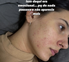 Em suas redes sociais, Ana relatou que convive com acne há muitos anos e que decidiu iniciar o tratamento como parte de uma rotina mais cuidadosa com sua saúde e aparência.