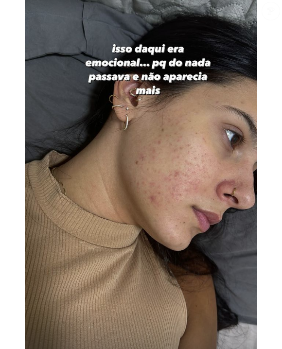 Em suas redes sociais, Ana relatou que convive com acne há muitos anos e que decidiu iniciar o tratamento como parte de uma rotina mais cuidadosa com sua saúde e aparência.