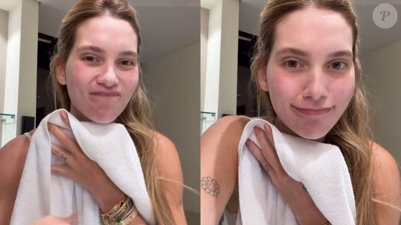 Influenciadora detalha tratamento com botox para controle da enxaqueca após episódio recente