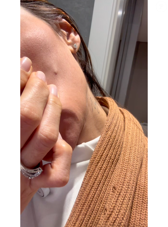 Deformações no rosto de Maíra Cardi é semelhante a uma espinha. Em seu vídeo, a influenciadora deixou um recado importante aos fãs