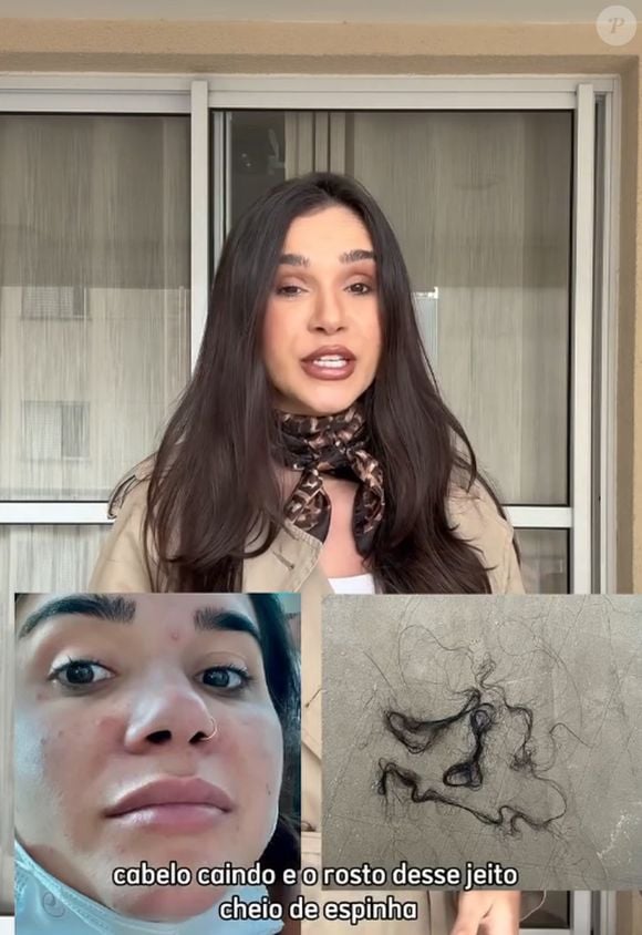 Influenciadora mostra corpo antes e depois do uso de anabolizantes e relata queda de cabelo e espinhas