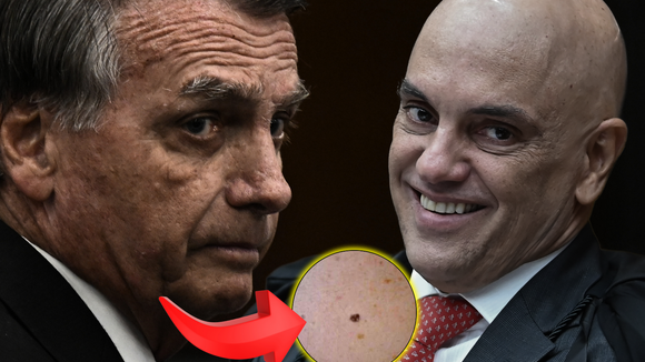 Jair Bolsonaro tem 'nevo melanocítico' e pede autorização de Alexandre de Moraes para procedimento na pele; dermatologista explica