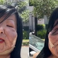 'Olha que lindo, ficou babado': Juju do Pix exibe resultado de nova cirurgia plástica, mas é detalhe no rosto que rouba a cena em antes e depois