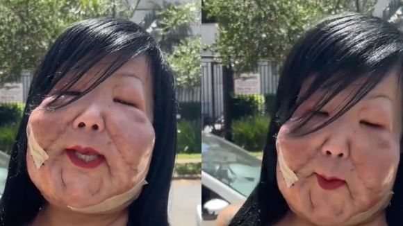 'Olha que lindo, ficou babado': Juju do Pix exibe resultado de nova cirurgia plástica, mas é detalhe no rosto que rouba a cena em antes e depois