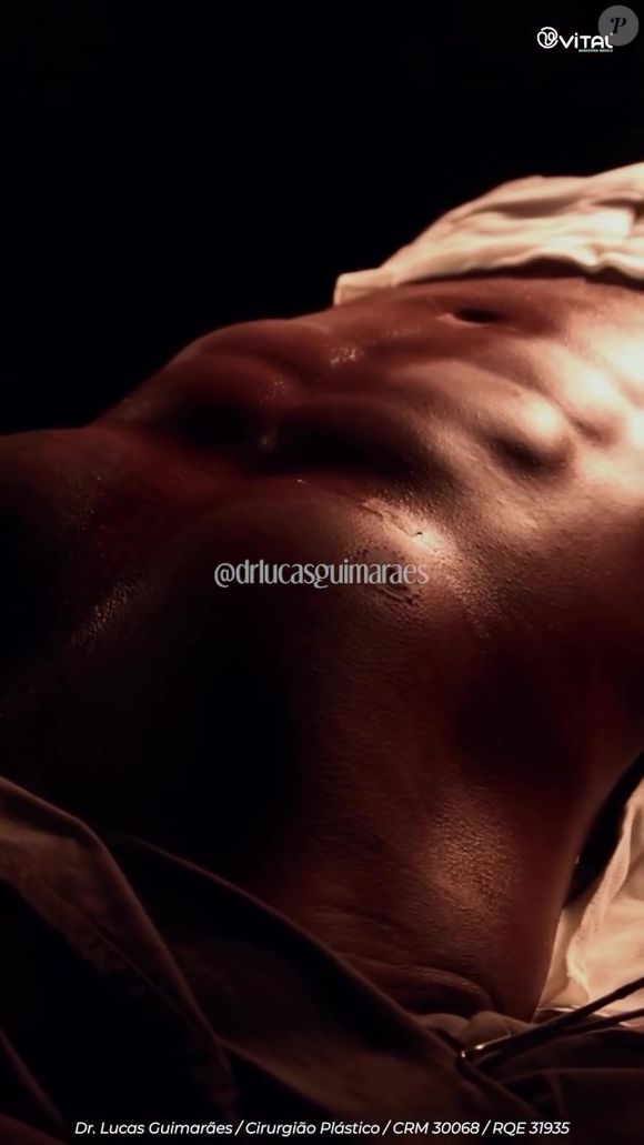 Lipo HD de Davi Brito: ‘Ocorreu tudo bem. Já estou com o meu resultado aqui, agora é recuperar’