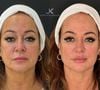 JK Estética Avançada: Nadine fez preenchimento labial, da região do mento e da fossa canina, uma rinomodelação suave e aplicação estratégica de toxina botulínica.