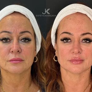 JK Estética Avançada: Nadine fez preenchimento labial, da região do mento e da fossa canina, uma rinomodelação suave e aplicação estratégica de toxina botulínica.