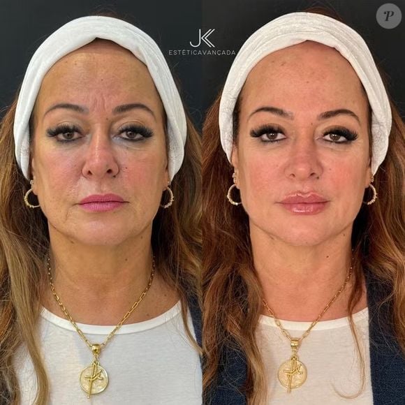 JK Estética Avançada: Nadine fez preenchimento labial, da região do mento e da fossa canina, uma rinomodelação suave e aplicação estratégica de toxina botulínica.