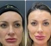 Andressa Urach passou por mais uma mudança em sua aparência. A modelo revelou através das redes sociais que fez um novo procedimento estético para aumentar os lábios e postou uma montagem com o antes e depois.