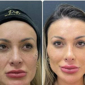 Andressa Urach passou por mais uma mudança em sua aparência. A modelo revelou através das redes sociais que fez um novo procedimento estético para aumentar os lábios e postou uma montagem com o antes e depois.