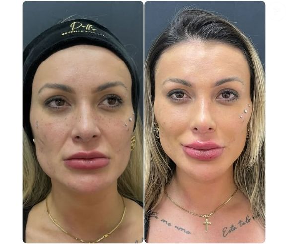 Andressa Urach passou por mais uma mudança em sua aparência. A modelo revelou através das redes sociais que fez um novo procedimento estético para aumentar os lábios e postou uma montagem com o antes e depois.