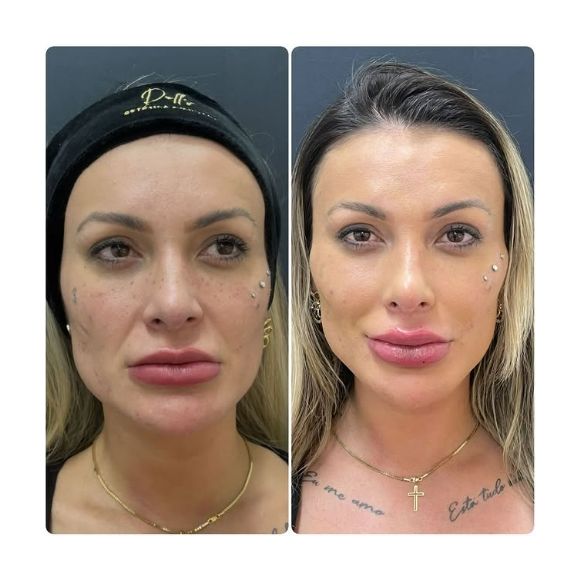 Andressa Urach passou por mais uma mudança em sua aparência. A modelo revelou através das redes sociais que fez um novo procedimento estético para aumentar os lábios e postou uma montagem com o antes e depois.