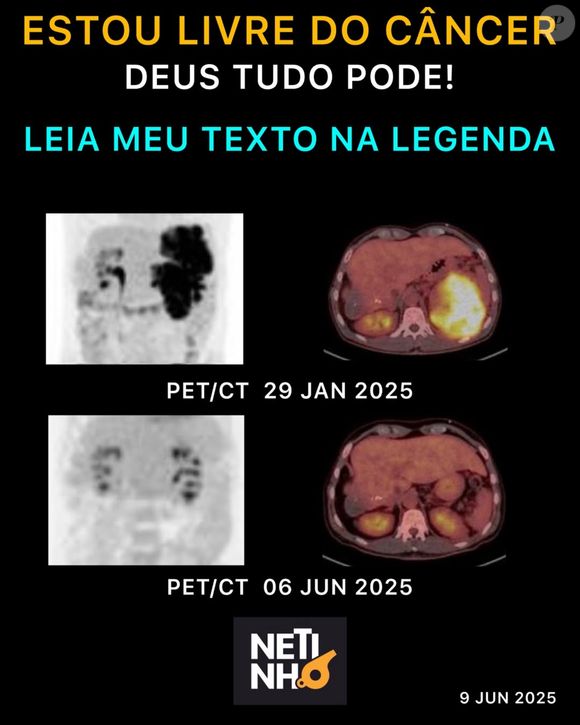 Equipe médica recomendou continuidade do protocolo para consolidar o resultado positivo