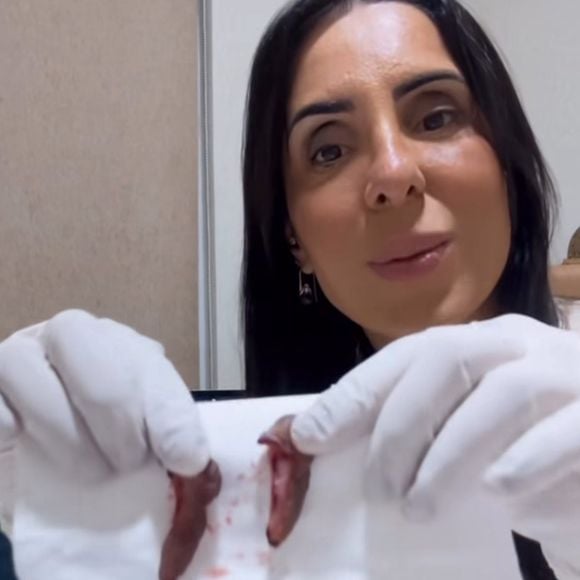 Mãe de Vanessa Lopes ainda publicou pedaços da pele retirada da vagina