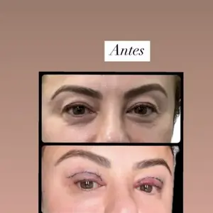 Poliana Rocha mostrou o antes e depois da blefaroplastia