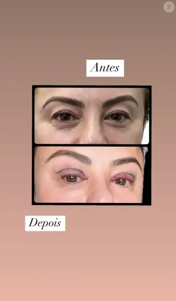Poliana Rocha mostrou o antes e depois da blefaroplastia