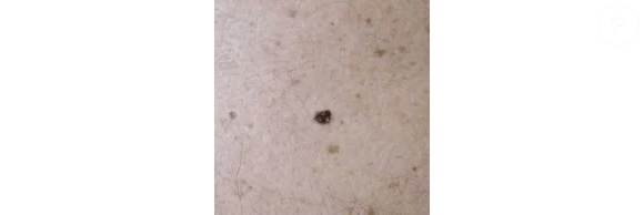 Especialistas alertam: pintas comuns podem se confundir com tumores malignos e exigem atenção médica