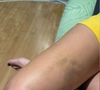 Madu Paim mostra perda machucada após agressões de MC Estudante