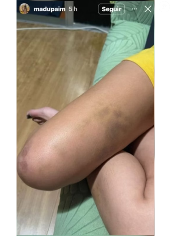 Madu Paim mostra perda machucada após agressões de MC Estudante