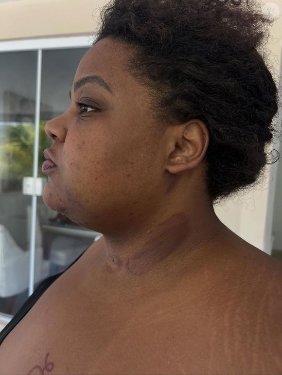 Funkeira mostra contorno facial após lipo e recebe apoio nas redes