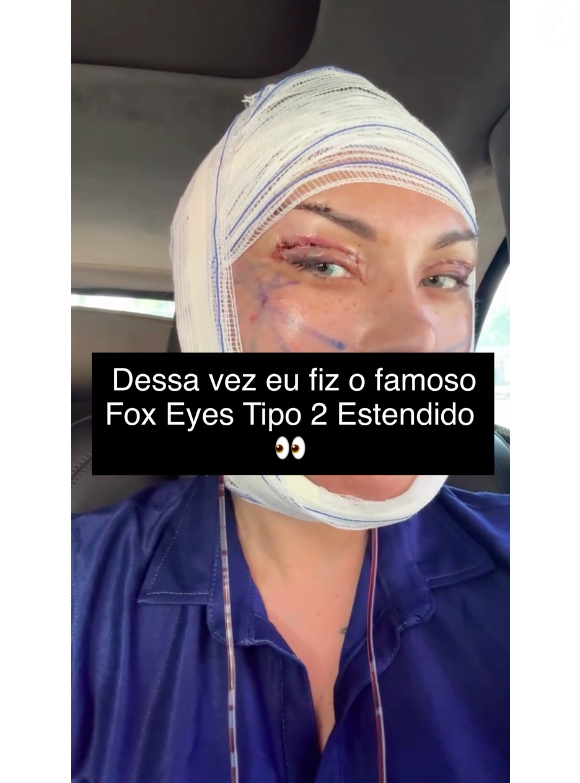 "Mas lembrando: o resultado final ainda NÃO apareceu, porque eu acabei de operar. Pós-operatório exige paciência, cuidado e acompanhamento", comentou Andressa Urach