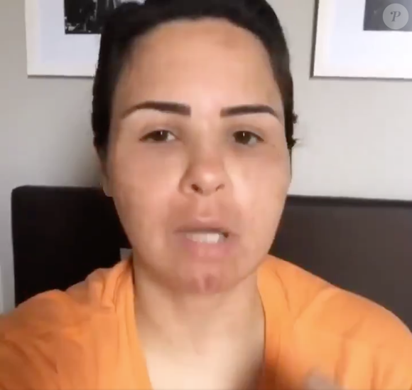 Na ocasião, Ana Paula Renault tinha acabado de realizar um procedimento estético no rosto e estava inchada