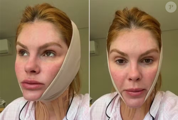 Essa não é a primeira vez que Bárbara Evans recorre a procedimentos para tratar a papada. Em novembro do ano passado, ela compartilhou com os seguidores uma intervenção feita com fios de sustentação e ácido hialurônico.