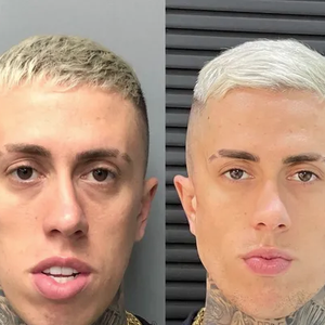 E esse foi o resultado da harmonização facial de MC Daniel