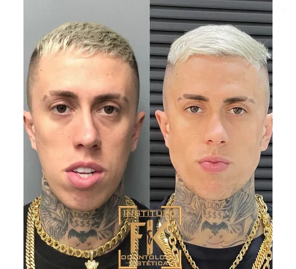 E esse foi o resultado da harmonização facial de MC Daniel