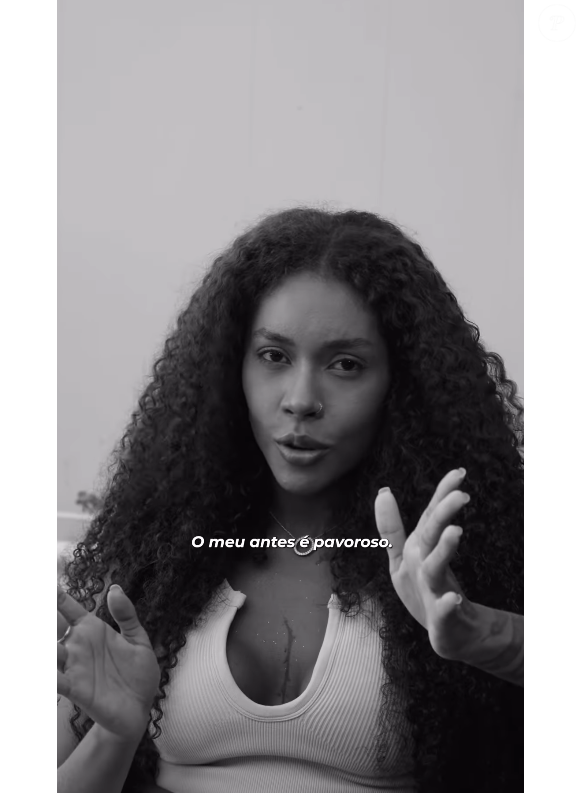 Depois de viralizar nas redes sociais com seu antes e depois, o perfil de Giovanna Jacobina no Instagram publicou um vídeo da irmã de Gracyanne explicando sua cirurgia ortognática