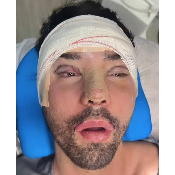 Rico Melquiades ficou assim após as últimas cirurgias, feitas há poucos meses