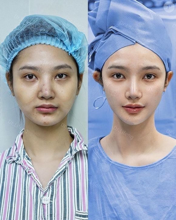 Resultado das técnicas do Dr. Lifeng é um procedimento sem cicatrizes e natural
