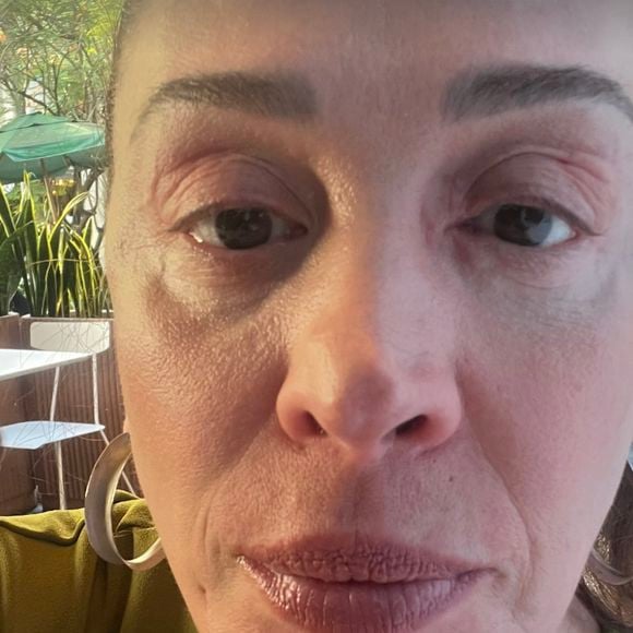 Claudia Raia mostrou rosto inchado aos seguidores por conta de angioedema