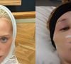 Antes e depois de Malu Borges: resultado definitivo da rinoplastia da influenciadora vai te impressionar e querer fazer uma agora mesmo