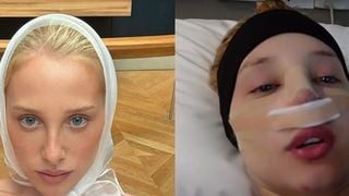 Antes e depois de Malu Borges: resultado DEFINITIVO da rinoplastia da influenciadora é impressionante; veja fotos!
