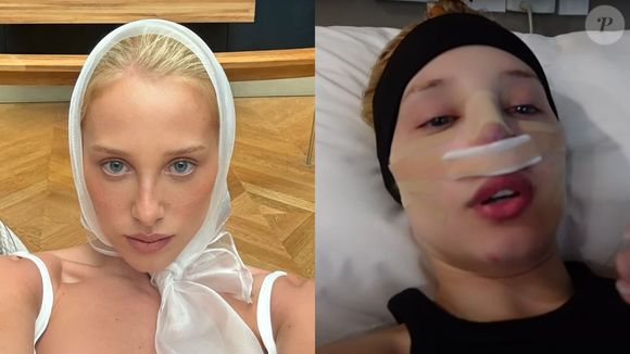 Antes e depois de Malu Borges: resultado definitivo da rinoplastia da influenciadora vai te impressionar e querer fazer uma agora mesmo