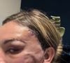Andressa Urach está com o rosto muito inchado e cheio de hematomas