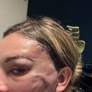 Andressa Urach está com o rosto muito inchado e cheio de hematomas