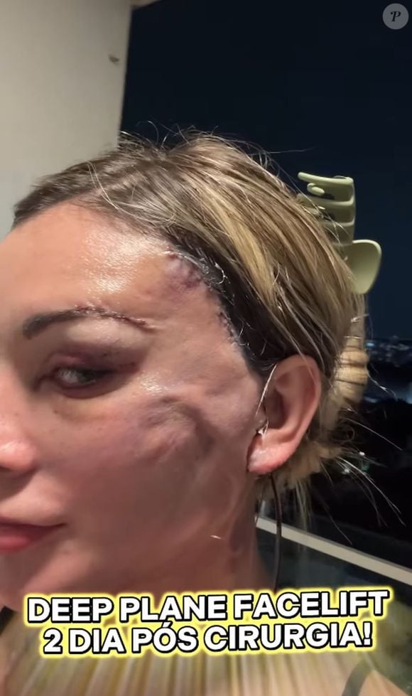 Andressa Urach está com o rosto muito inchado e cheio de hematomas